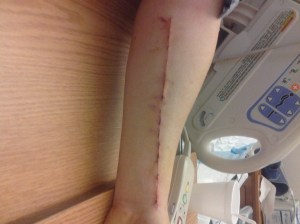 Erik VanFleet Removal of artery from left arm for Quad Bypass Open Heart Surgery Dec 21, 2012