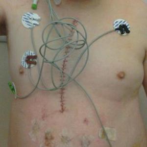ErikVanFleetDec26201_PostQuadBypass_MainHeartIncision+4HorizontalIncisions_1